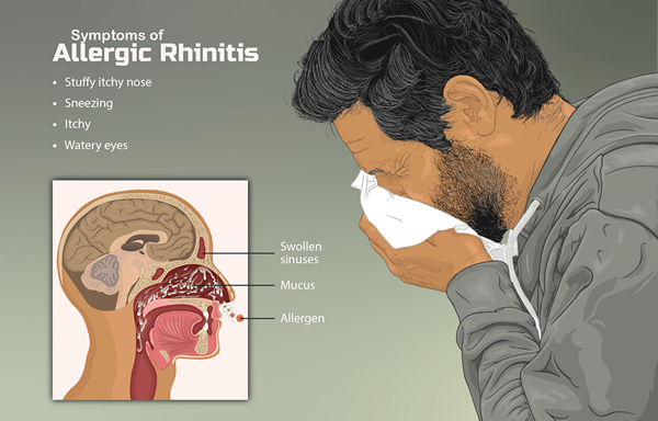 Was ist der Unterschied zwischen Asthma und allergischer Rhinitis