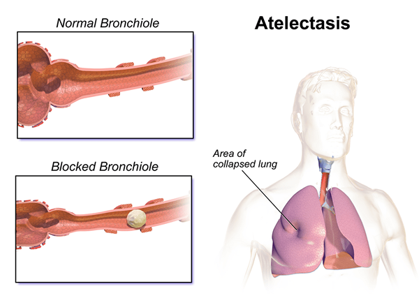 ¿Cuál es la diferencia entre atelectasis y neumonía?