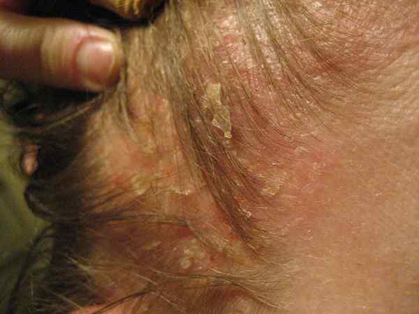 Apa perbedaan antara dermatitis atopik dan sebors