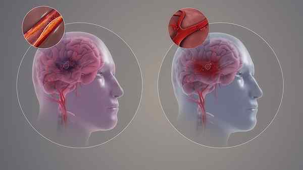 ¿Cuál es la diferencia entre la parálisis de Bell y el accidente cerebrovascular?