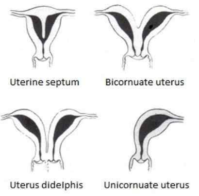 ¿Cuál es la diferencia entre el útero de Bicornuate y Septate?