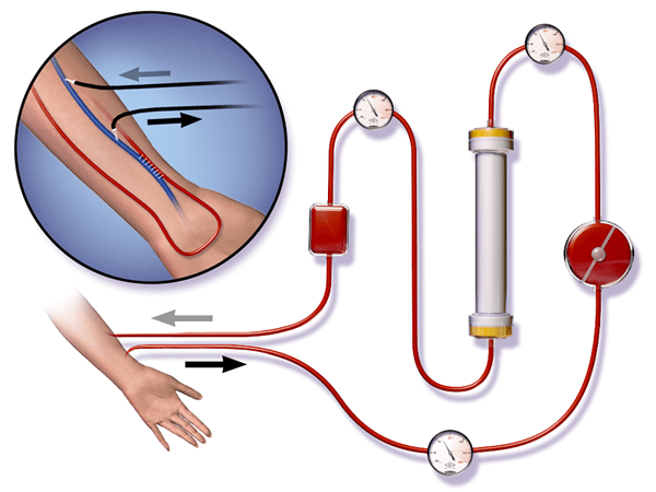 Apa perbedaan antara transfusi darah dan dialisis