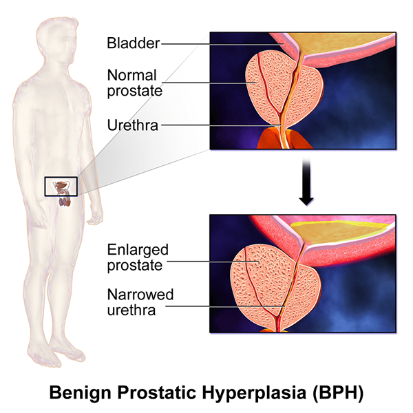 Apakah perbezaan antara BPH dan prostatitis