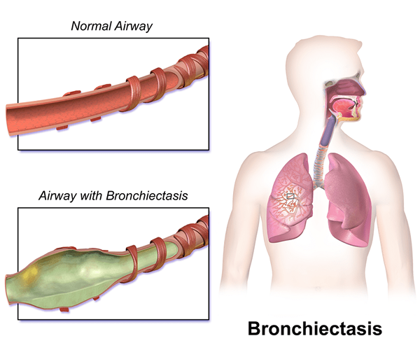 Quelle est la différence entre la bronchectasie et la fibrose kystique