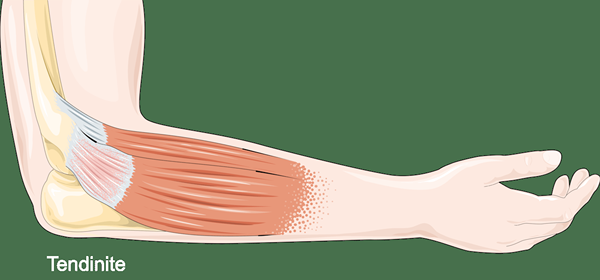 Quelle est la différence entre la bursite et la tendonite