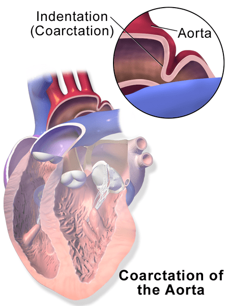 Quelle est la différence entre la coarctation et l'arc aortique hypoplasique