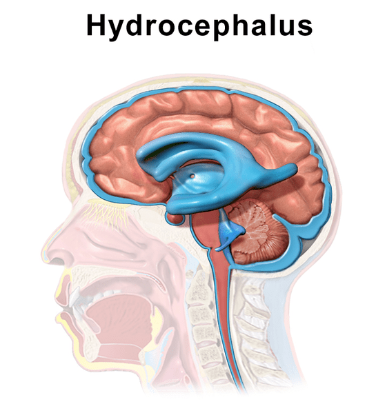 Quelle est la différence entre la communication et la non-communication de l'hydrocéphalie