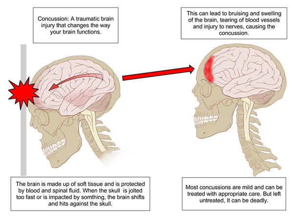 Apakah perbezaan antara gegaran dan kecederaan otak traumatik