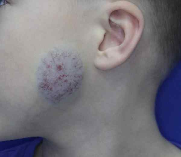 ¿Cuál es la diferencia entre hemangiomas congénitos e infantiles?