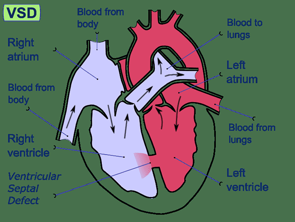 Was ist der Unterschied zwischen Herzinsuffizienz und angeborenen Herzerkrankungen