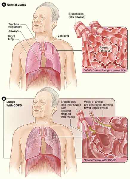 Apa perbedaan antara kanker COPD dan paru -paru