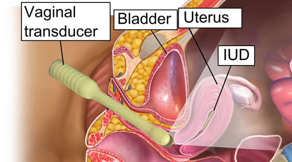 Quelle est la différence entre le cuivre et le DIU hormonal