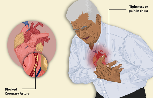 Was ist der Unterschied zwischen Costochondritis und Herzinfarkt