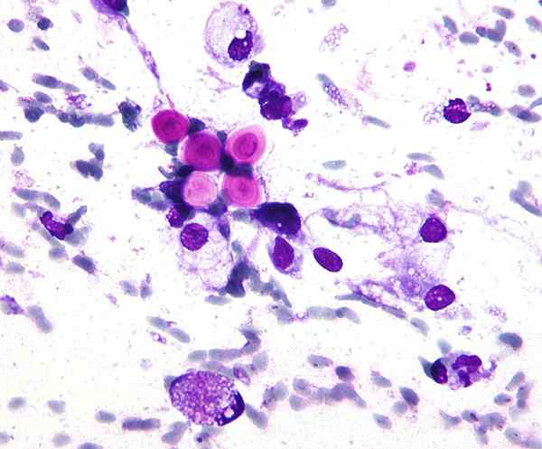 ¿Cuál es la diferencia entre Cryptococcus neoformans y Candida albicans?