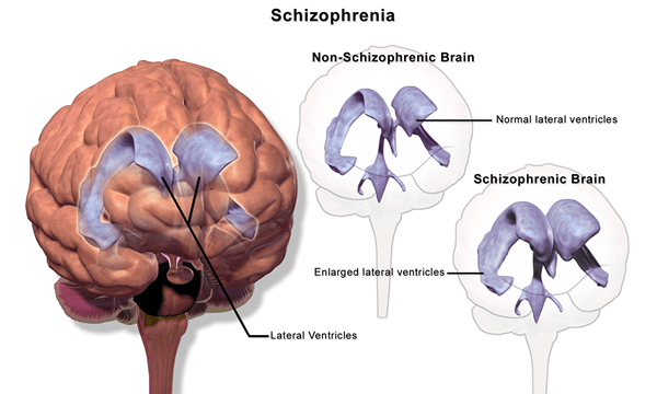 Apakah perbezaan antara kemurungan dan skizofrenia