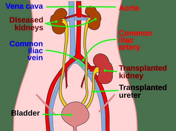 ¿Cuál es la diferencia entre diálisis y trasplante de riñón?