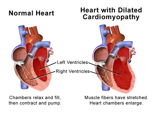 ¿Cuál es la diferencia entre la miocardiopatía dilatada y la miocardiopatía hipertrófica?