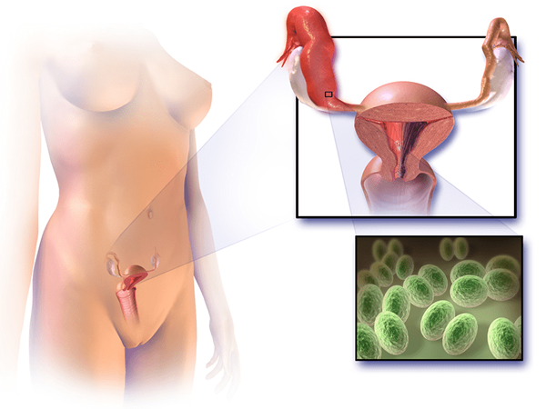¿Cuál es la diferencia entre la endometriosis y la enfermedad inflamatoria pélvica?
