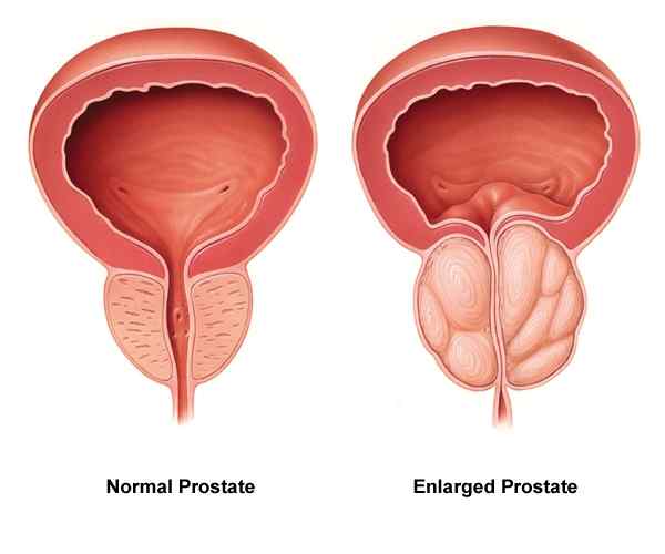 Apakah perbezaan antara kanser prostat dan prostat yang diperbesar