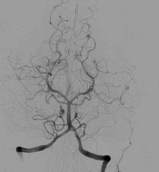 Apakah perbezaan antara fluoroskopi dan angiografi