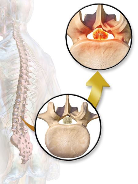 Apakah perbezaan antara stenosis foraminal dan stenosis tulang belakang