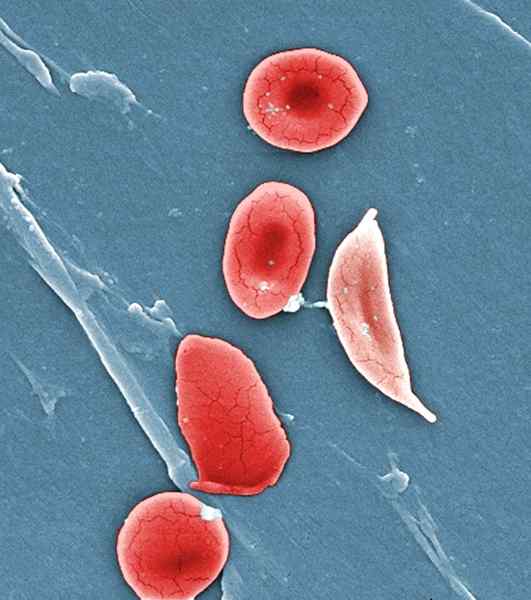 Quelle est la différence entre G6PD et drépanocytose