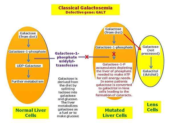 ¿Cuál es la diferencia entre la deficiencia de galactosemia y galactoquinasa?