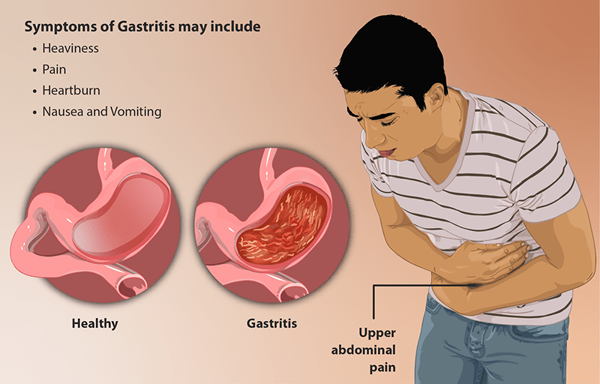 ¿Cuál es la diferencia entre gastritis y cáncer de estómago?
