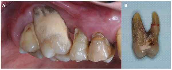 Quelle est la différence entre la gingivite et la parodontite