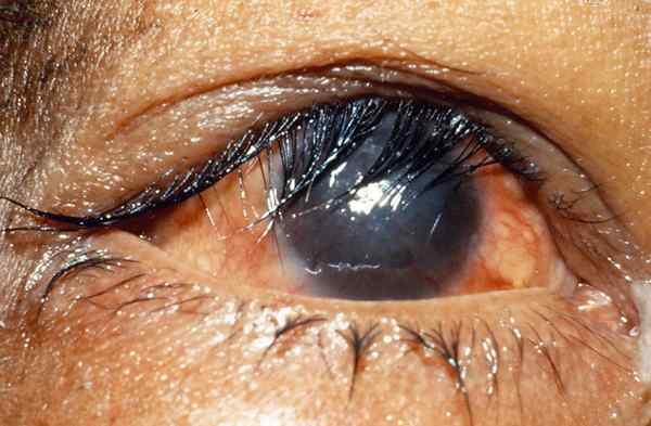 Was ist der Unterschied zwischen Glaukom und Trachom