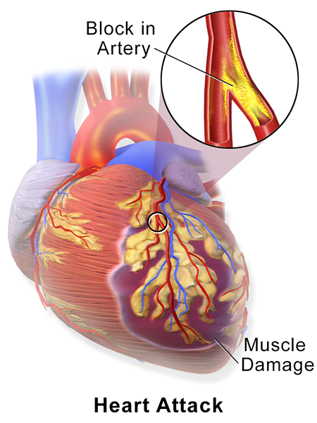 Quelle est la différence entre la crise cardiaque et la douleur gastrique