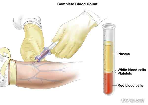 ¿Cuál es la diferencia entre el hematocrito y el recuento de glóbulos rojos?