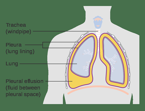 Was ist der Unterschied zwischen Hemothorax und Pleuraerguss