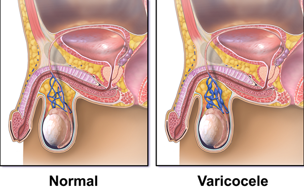 ¿Cuál es la diferencia entre hidrocele y varicocele?