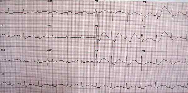 Quelle est la différence entre l'hyperkaliémie et l'hypokaliémie