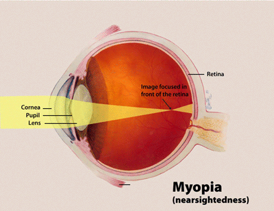 Was ist der Unterschied zwischen Hypermetropie und Myopie