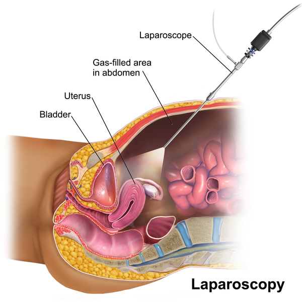 Apakah perbezaan antara histeroskopi dan laparoskopi