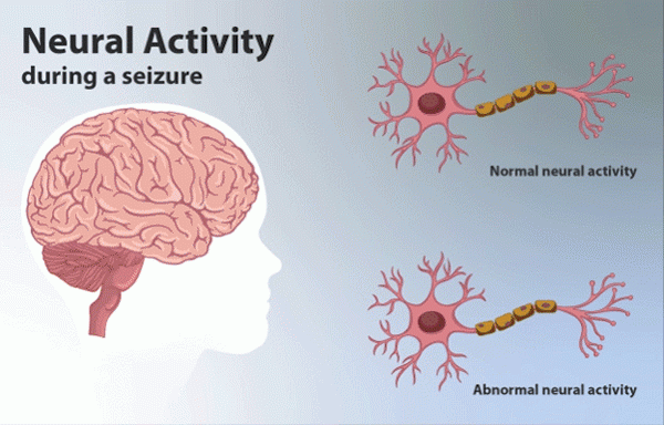 Apakah perbezaan antara epilepsi idiopatik dan kriptogenik