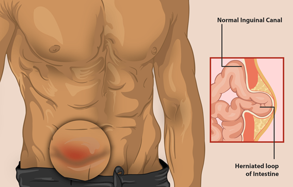 ¿Cuál es la diferencia entre hernia inguinal e hidrocele?