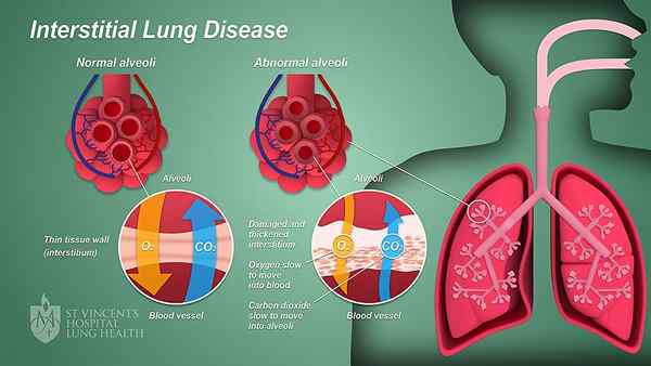 Apakah perbezaan antara penyakit paru -paru interstisial dan fibrosis pulmonari