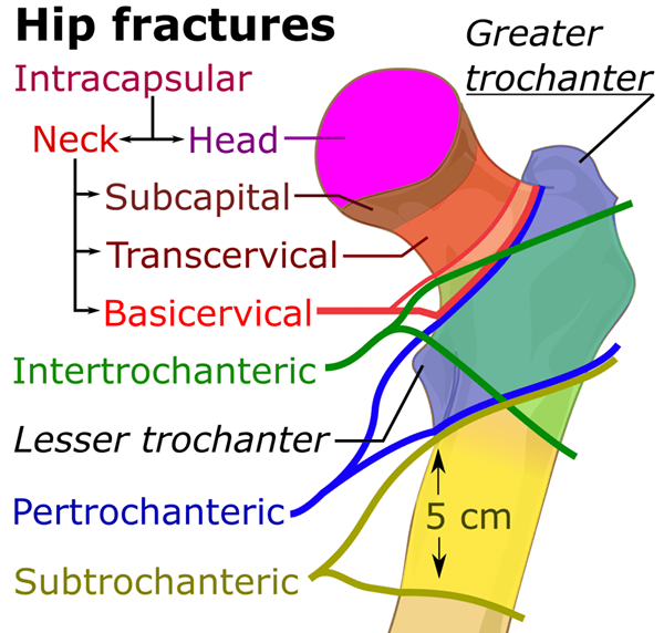 Apa perbedaan antara fraktur leher femur intrakapsular dan ekstrakapsular