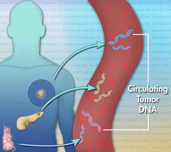 Apakah perbezaan antara sel -sel tumor yang terpencil dan micrometastases