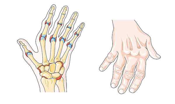 Apakah perbezaan antara arthritis idiopatik remaja dan arthritis rheumatoid