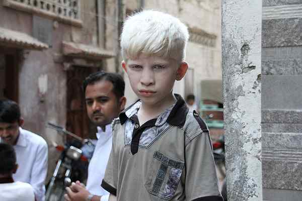Quelle est la différence entre leucoderme et l'albinisme