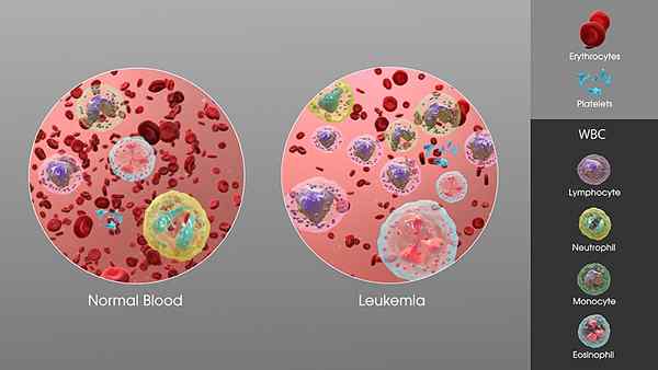 ¿Cuál es la diferencia entre leucemia y leucopenia?