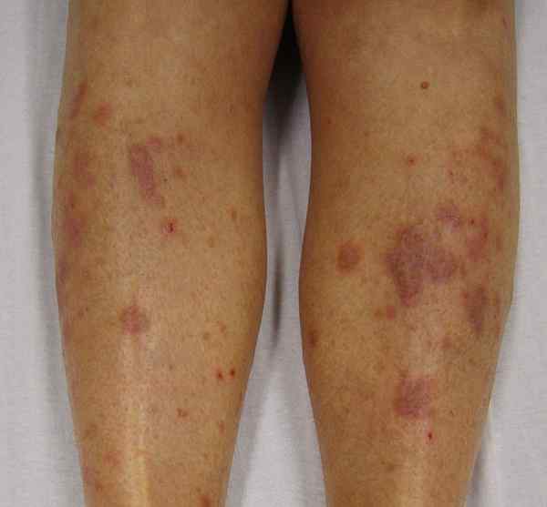 Was ist der Unterschied zwischen Lichen Planus und Lupus erythematodes