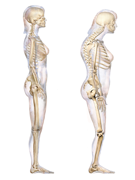 Apa perbedaan antara kiphosis lordosis dan skoliosis