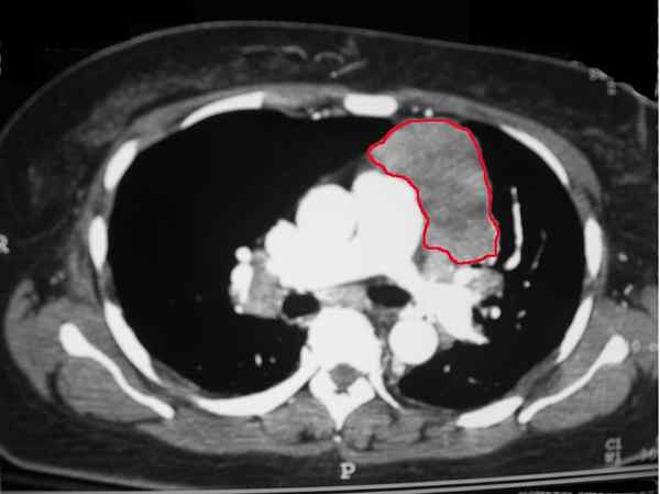 Quelle est la différence entre la masse pulmonaire et la masse médiastinale