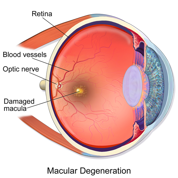 ¿Cuál es la diferencia entre la degeneración macular y el edema macular?