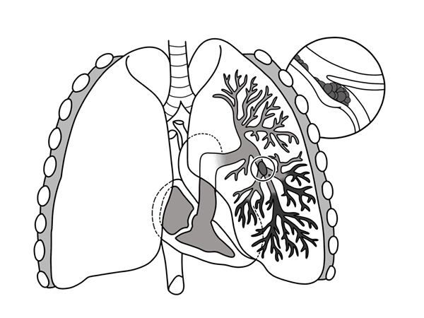¿Cuál es la diferencia entre la embolia pulmonar masiva y submasiva?